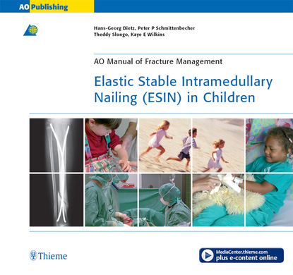 Elastic Stable Intramedullary Nailing (ESIN) in Children